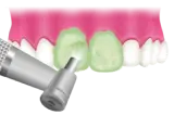歯の表面の研磨